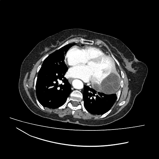 File:Cardiac hydatid disease (Radiopaedia 64684-73611 Axial with contrast 30).jpg