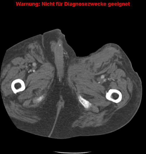 File:Cardiac perforation following transcatheter aortic valve implantation (Radiopaedia 23714-23863 B 22).png