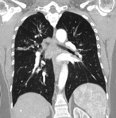 Cardiac sarcoidosis (Radiopaedia 74548-85534 Coronal lung window 42).jpg
