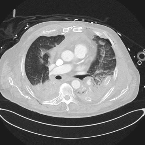 Cardiac trauma (Radiopaedia 32874-33858 Axial lung window 26).jpg