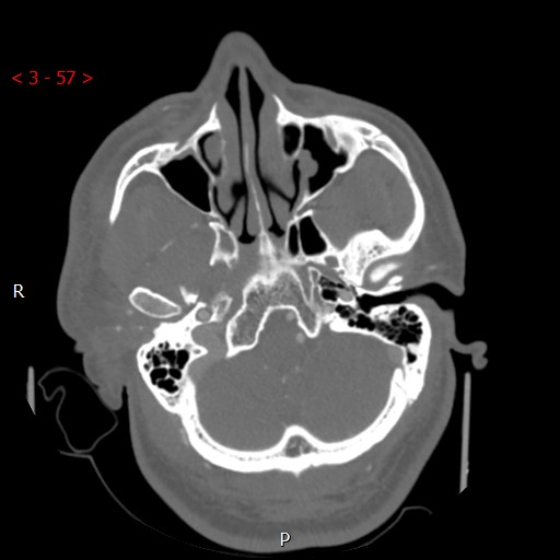 Caroticocavernous fistula (Radiopaedia 42346-45457 A 15).jpg