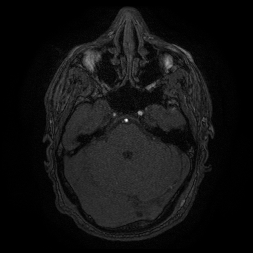 Carotid arterial dissection with acute cerebral infarction (Radiopaedia 26636-26784 MRA 124).jpg