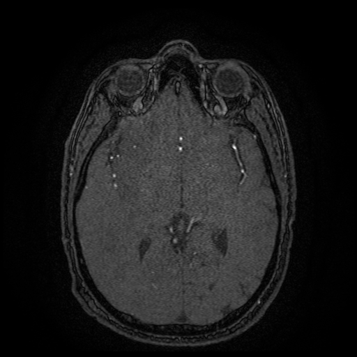 Carotid arterial dissection with acute cerebral infarction (Radiopaedia 26636-26784 MRA 84).jpg