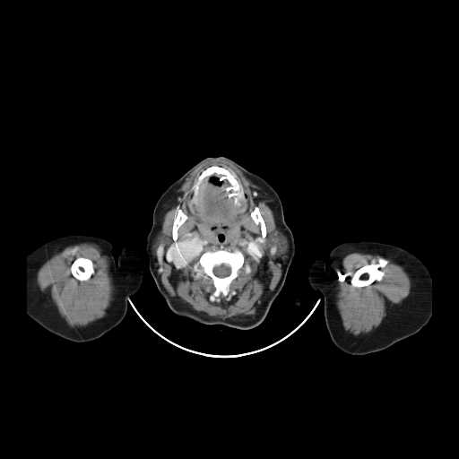 File:Carotid body tumor (Radiopaedia 21021-20948 B 9).jpg