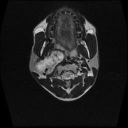 File:Carotid body tumor (Radiopaedia 30208-30823 Axial T2 12).jpg