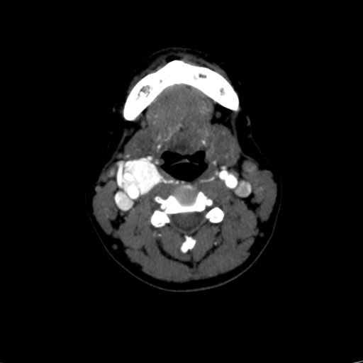 File:Carotid body tumor (Radiopaedia 39845-42300 B 33).jpg