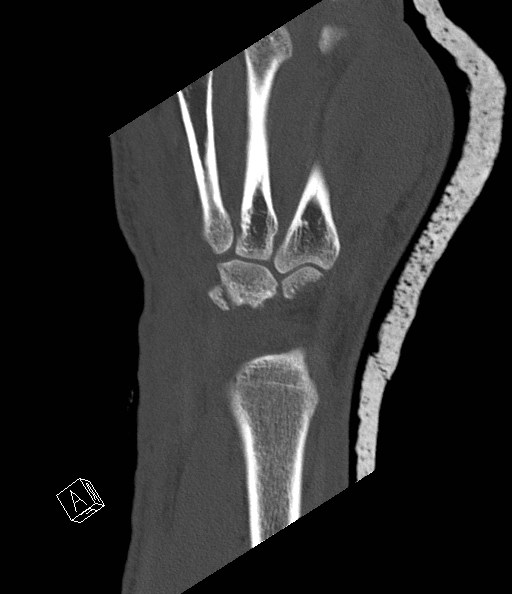 File:Carpal fractures (smart watch impaction) (Radiopaedia 55844-62430 Coronal bone window 5).jpg