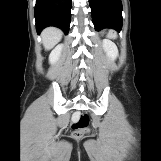 Castleman disease with fibrous pseudotumor in the abdomen (Radiopaedia 77296-89373 B 74).jpg