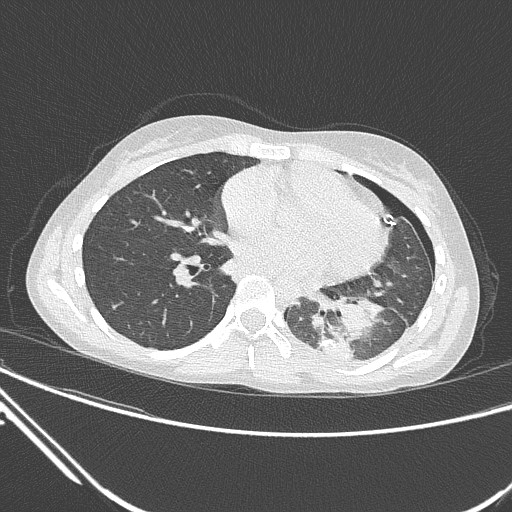 Catamenial pneumothorax (Radiopaedia 27946-28197 lung window 95).jpg