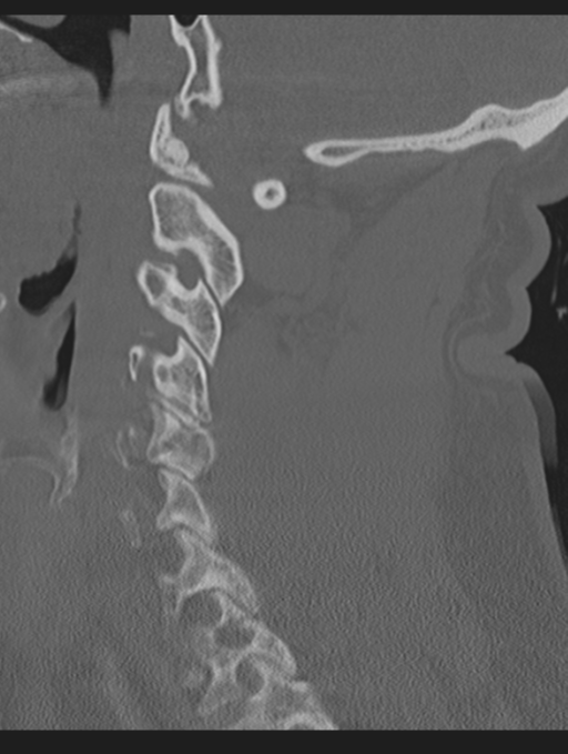 Cavernoma of cervical cord (Radiopaedia 50838-56346 Sagittal bone window 32).png