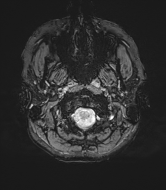 File:Cavernoma with bleed - midbrain (Radiopaedia 54546-60773 Axial SWI 3).png