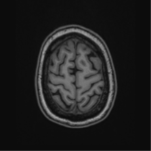 Cavernoma with bleed - midbrain (Radiopaedia 54546-60774 Axial T1 49).png
