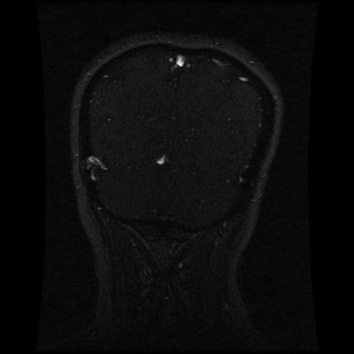 Cavernoma with developmental venous anomaly (Radiopaedia 22470-22507 MRV 39).jpg