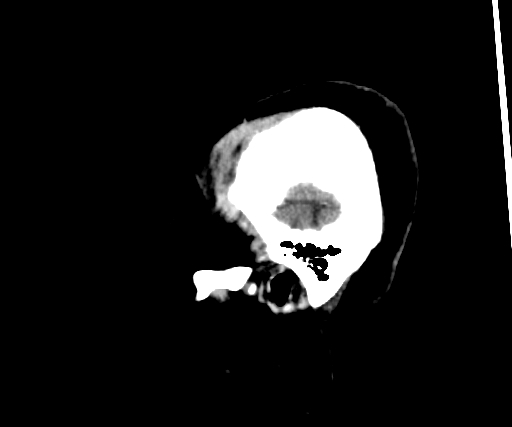 Cavernous hemangioma of the cerebellar falx (Radiopaedia 73025-83723 B 28).jpg