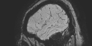 Cavernous hemangioma of the cerebellar falx (Radiopaedia 73025-83724 Sagittal BOLD 23).jpg