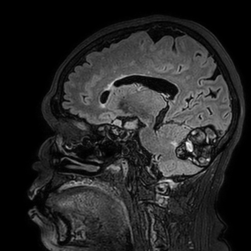 Cavernous hemangioma of the cerebellar falx (Radiopaedia 73025-83724 Sagittal FLAIR 131).jpg