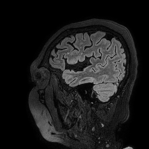 Cavernous hemangioma of the cerebellar falx (Radiopaedia 73025-83724 Sagittal FLAIR 182).jpg