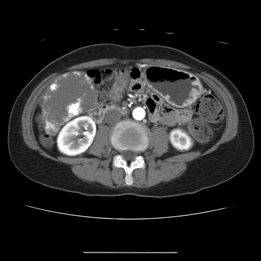 Cavernous hepatic hemangioma (Radiopaedia 75441-86667 A 59).jpg