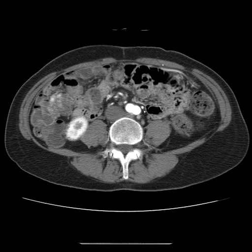 Cavernous hepatic hemangioma (Radiopaedia 75441-86667 A 67).jpg
