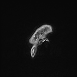 Cavernous sinus meningioma (Radiopaedia 63682-72367 Sagittal T1 C+ 169).jpg