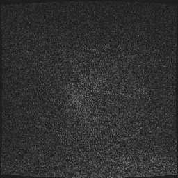Cavernous sinus meningioma (Radiopaedia 63682-72367 Sagittal T1 C+ 4).jpg