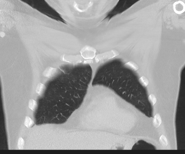 Cavitating pneumonia (Radiopaedia 45998-50329 Coronal lung window 11).png