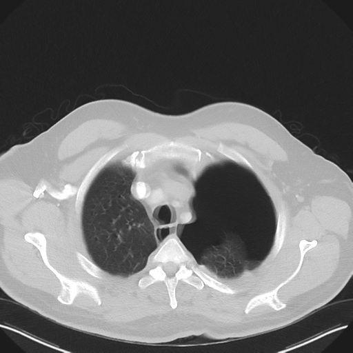 File:Cavitating pneumonia complicated by pneumothorax (Radiopaedia 48149-52994 Axial lung window 13).png