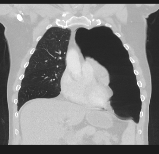 Cavitating pneumonia complicated by pneumothorax (Radiopaedia 48149-52994 Coronal lung window 21).png
