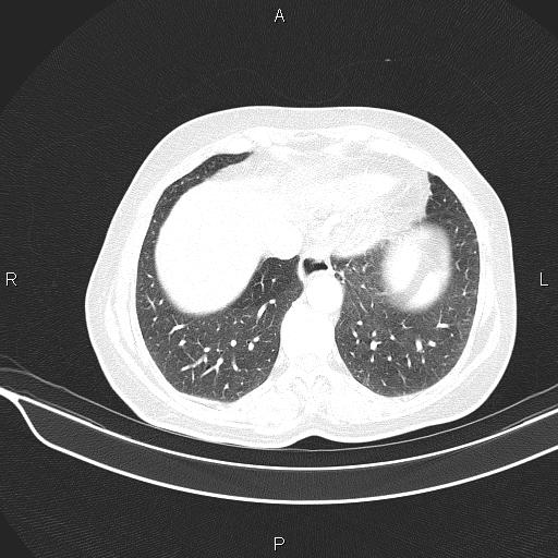 Cecal cancer (Radiopaedia 85610-101358 Axial lung window 50).jpg