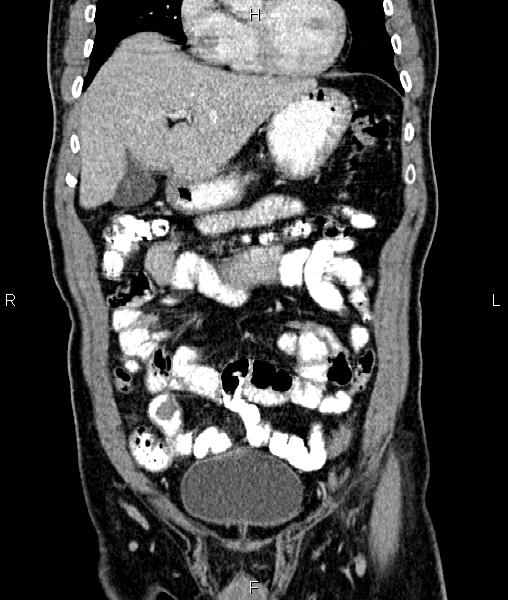 Cecal cancer with appendiceal mucocele (Radiopaedia 91080-108651 D 21).jpg