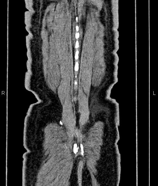 Cecal cancer with appendiceal mucocele (Radiopaedia 91080-108651 D 71).jpg