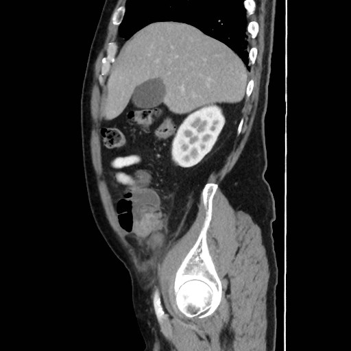 Cecal mass causing appendicitis (Radiopaedia 59207-66531 C 15).jpg