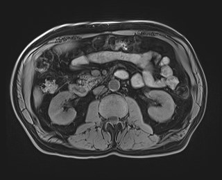 Cecal mass causing appendicitis (Radiopaedia 59207-66532 Axial T1 63).jpg
