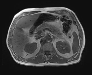 Cecal mass causing appendicitis (Radiopaedia 59207-66532 Axial T1 in-phase 47).jpg