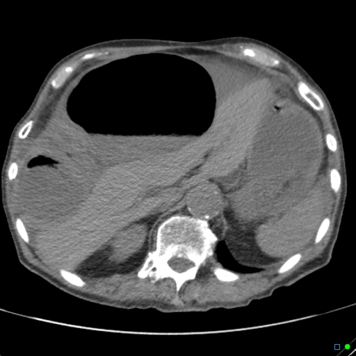 Cecal volvulus - atypical (Radiopaedia 21637-21588 non-contrast 18).jpg