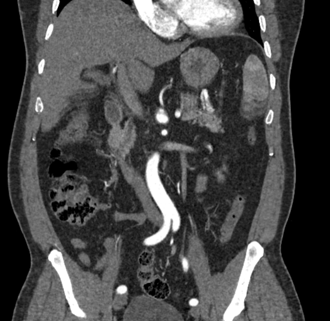 Celiac artery dissection (Radiopaedia 52194-58080 C 47).jpg