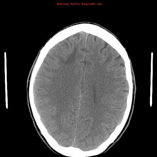 File:Central nervous system vasculitis (Radiopaedia 8410-9234 Axial non-contrast 18).jpg