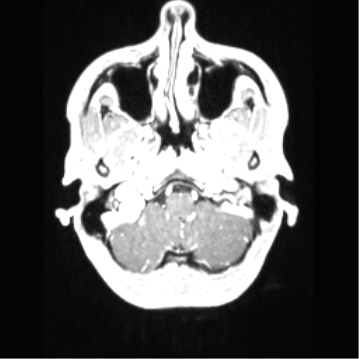 Central neurocytoma (Radiopaedia 37664-39557 Axial T1 C+ 13).png