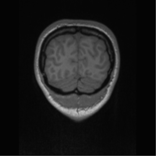 Central neurocytoma (Radiopaedia 37664-39557 Coronal T1 11).png
