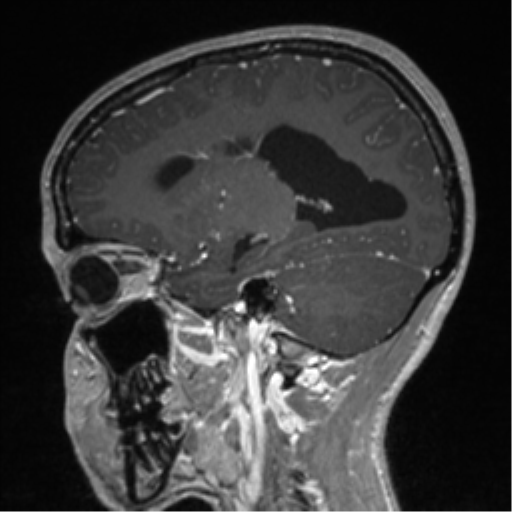 Central neurocytoma (Radiopaedia 37664-39557 Sagittal T1 C+ 34).png