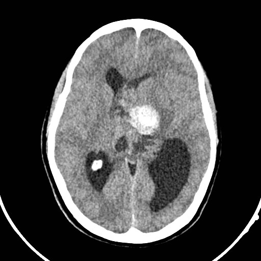 Central neurocytoma (Radiopaedia 84497-99871 Axial non-contrast 25).jpg
