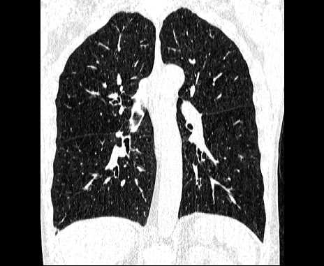 Centrilobular pulmonary emphysema (Radiopaedia 62468-70718 Coronal lung window 44).jpg