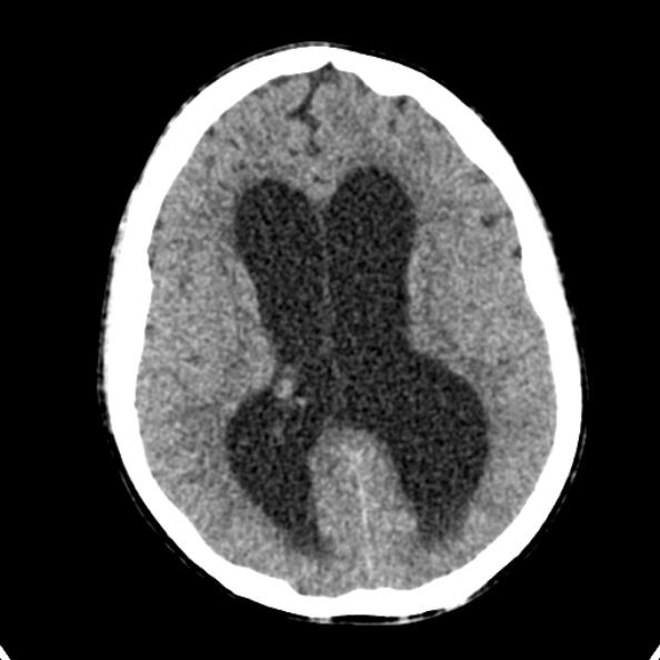 Cerebellar abscess secondary to mastoiditis (Radiopaedia 26284-26412 Axial non-contrast 91).jpg