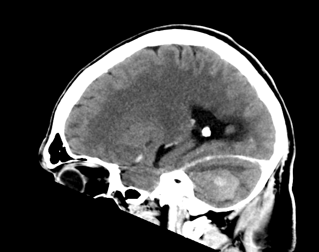 File:Cerebellar hemorrhage (Radiopaedia 37000-38671 Sagittal C+ 13).png