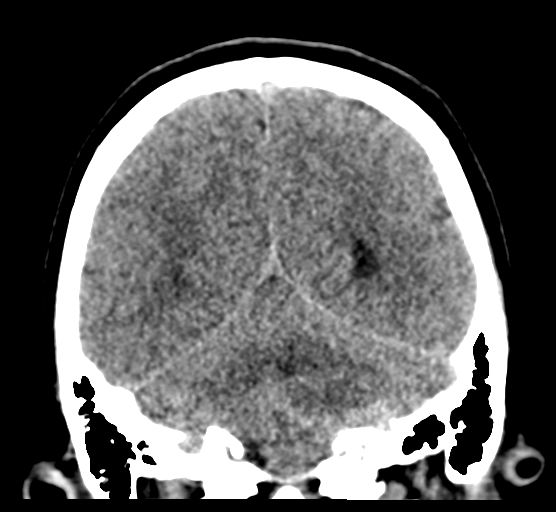 File:Cerebellar metastases - colorectal adenocarcinoma (Radiopaedia 40947-43652 Coronal non-contrast 68).png