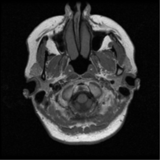 File:Cerebellar metastases - colorectal adenocarcinoma (Radiopaedia 40947-43655 Axial T1 3).png