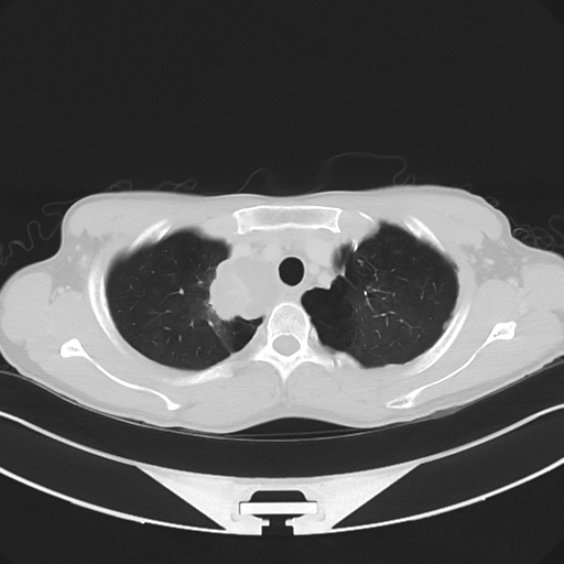 Cerebellar metastasis - adenocarcinoma lung (Radiopaedia 63184-71717 Axial lung window 15).png