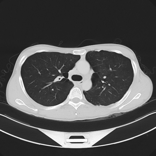 Cerebellar metastasis - adenocarcinoma lung (Radiopaedia 63184-71717 Axial lung window 25).png
