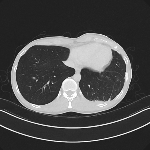 Cerebellar metastasis - adenocarcinoma lung (Radiopaedia 63184-71717 Axial lung window 53).png