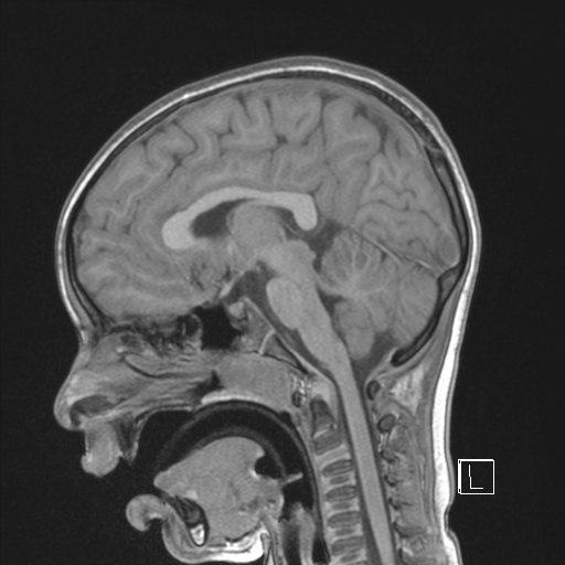 Cerebellar stroke (Radiopaedia 32202-33150 Sagittal T1 C+ 25).png
